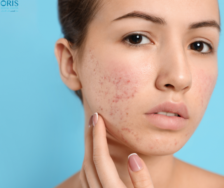 acne scars treatment