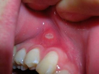 Recurrent Mouth Ulcers Canker Sores Aphthous Stomatitis