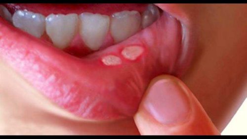 Recurrent Mouth Ulcers Canker Sores Aphthous Stomatitis