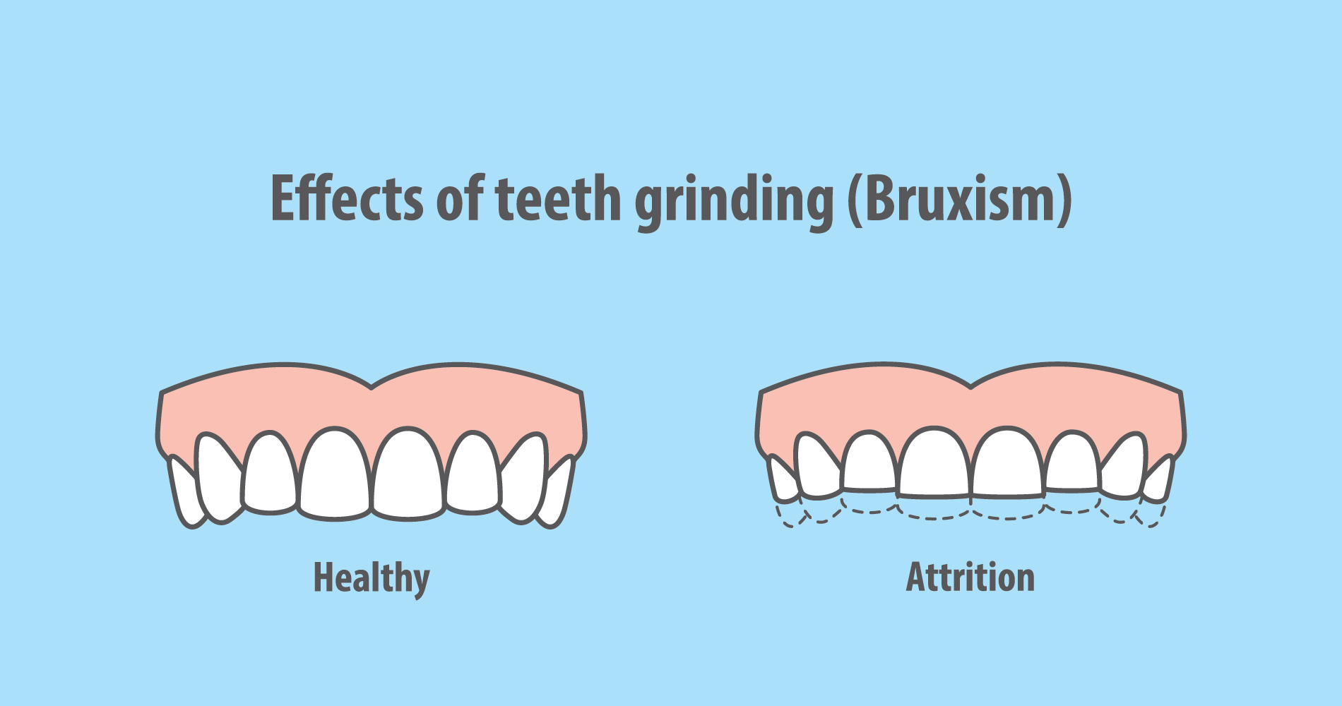 Teeth grinding and its consequences!