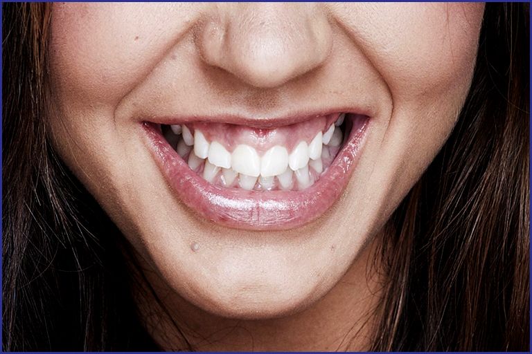 Gum Line Contouring For a Shapelier Smile - Oris Dental Center
