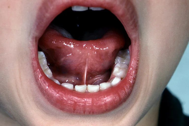 Tongue Tie | Short Tongue