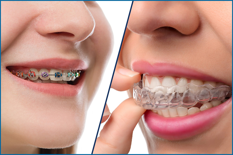 Invisible Braces or Traditional Braces. Know which suits you