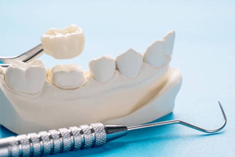 dental crowns for teeth