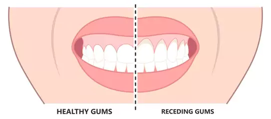 Gingival Recession