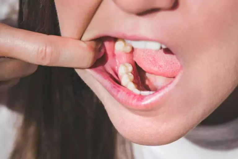 How to Prevent Gum Swelling: Best Oral Hygiene Practices