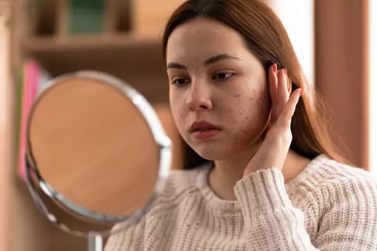 Understanding Acne Scar Treatment