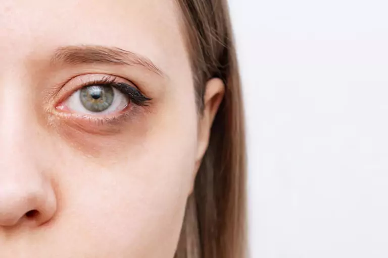 How to Reduce Dark Circles Naturally