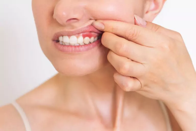 How to Prevent Gum Swelling: Best Oral Hygiene Practices