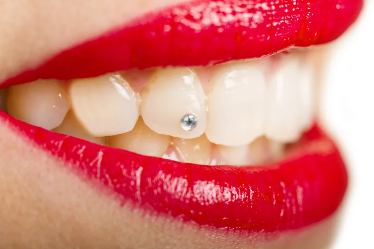 What is Hyperdontia (Extra Teeth) and Its Complications?