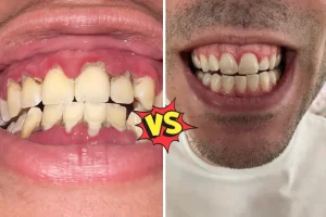 Gingivitis vs Periodontitis