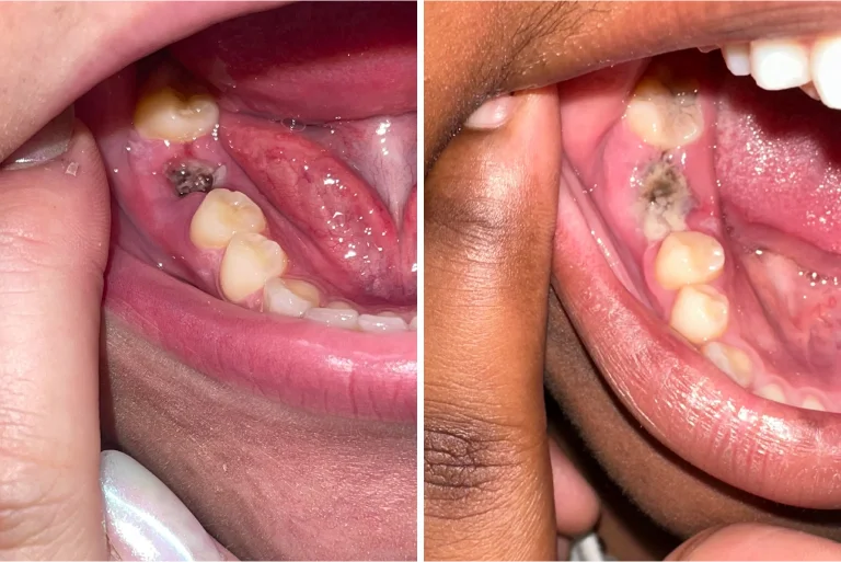 What is Hyperdontia (Extra Teeth) and Its Complications?