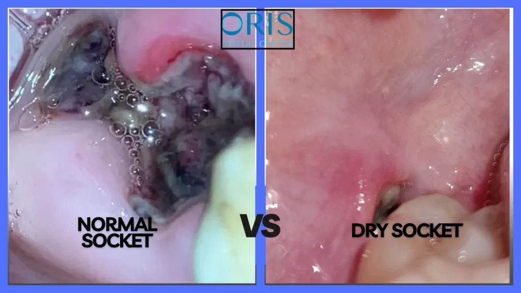 what does dry socket look like | normal socket after tooth extraction