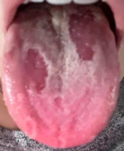 Geographic Tongue Pictures | Symptoms