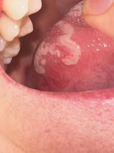 Geographic Tongue Treatments | Pictures