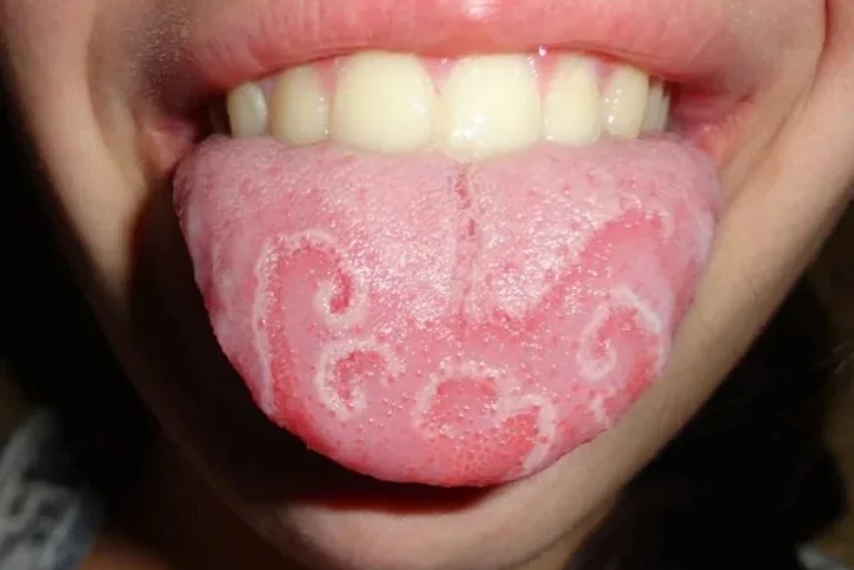 Geographic Tongue: Pictures, Symptoms and Treatments