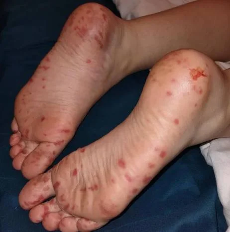 Hand Foot and Mouth Disease Picture
