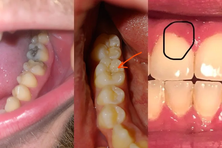 What Does a Cavity look like?