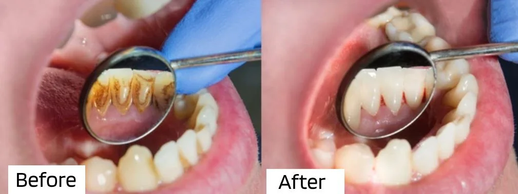 calculus bridge images - Before & After