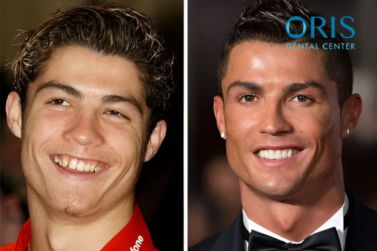 Celebrities With Veneers: