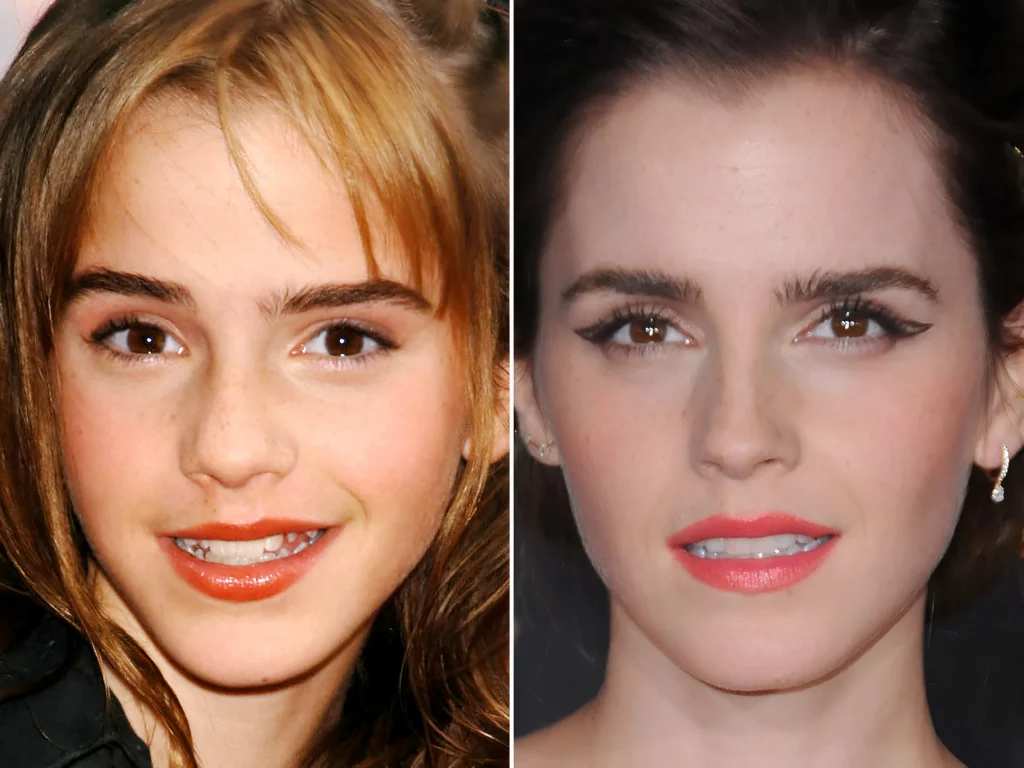 Emma Watson Before and After Veneers