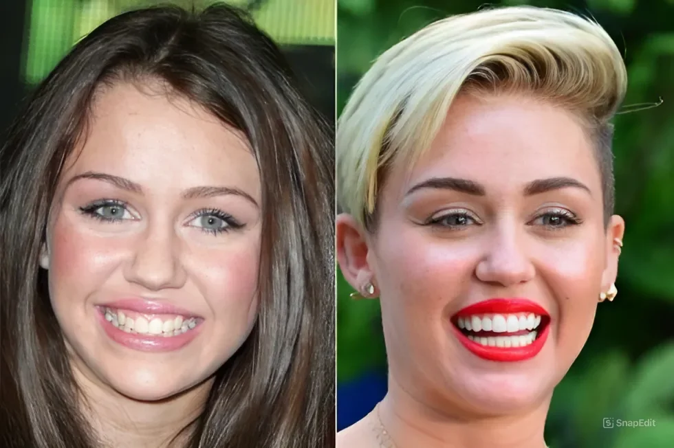 Miley Cyrus Before and After Veneers