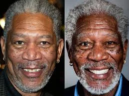 Morgan Freeman Before and After Veneers