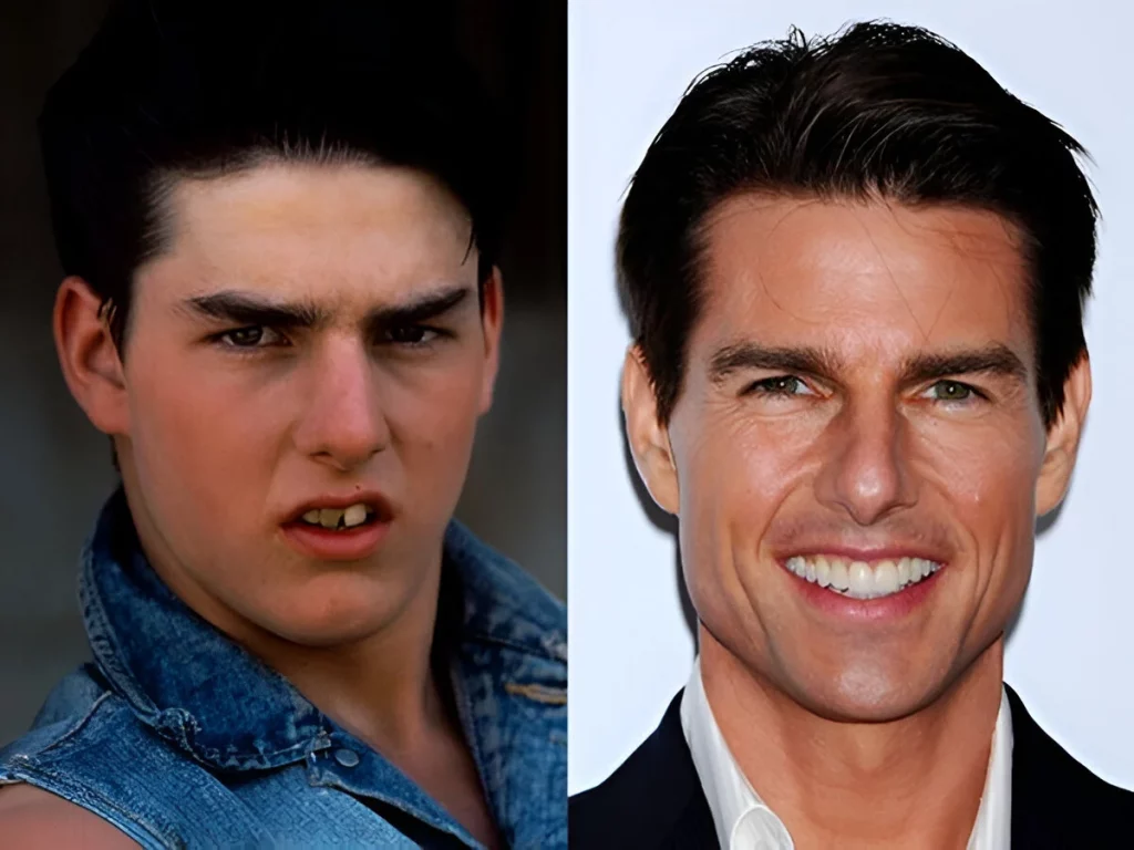 Tom cruise Before and After Veneers