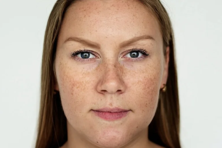 Melasma Treatment In Dubai