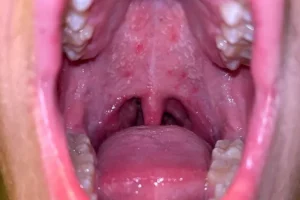 Red Spots on Roof Of the mouth | Red Dots On The palate