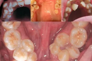 Hyperdontia Supernumerary Teeth