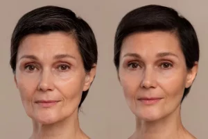 Radiofrequency Skin Tightening