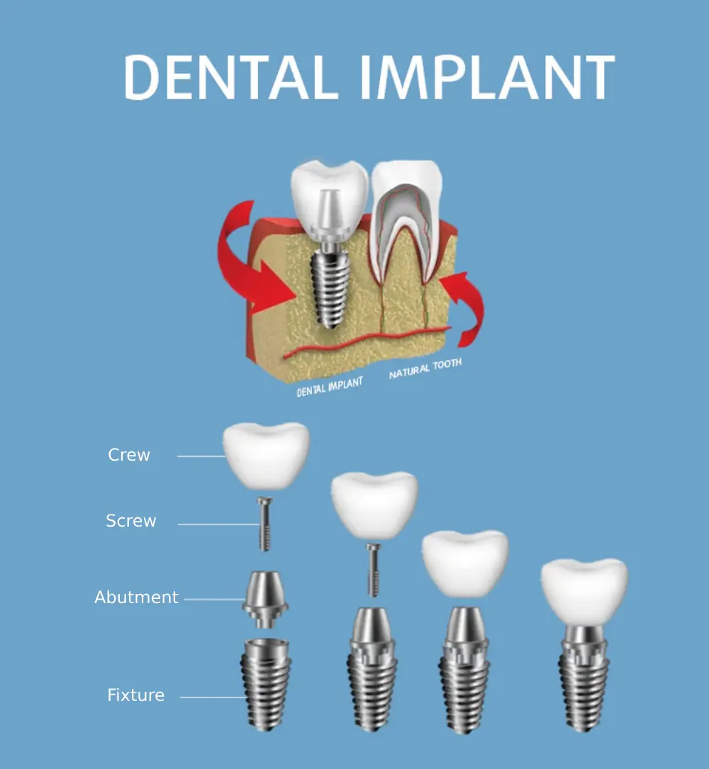 Dental Implant System