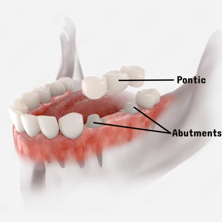 Dental Bridges: Postoperative Care